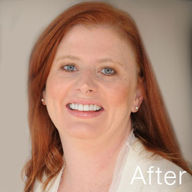 Actual patient after treatment